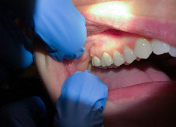 Best Emergency Root Canal Treatment in South Wenatchee, WA